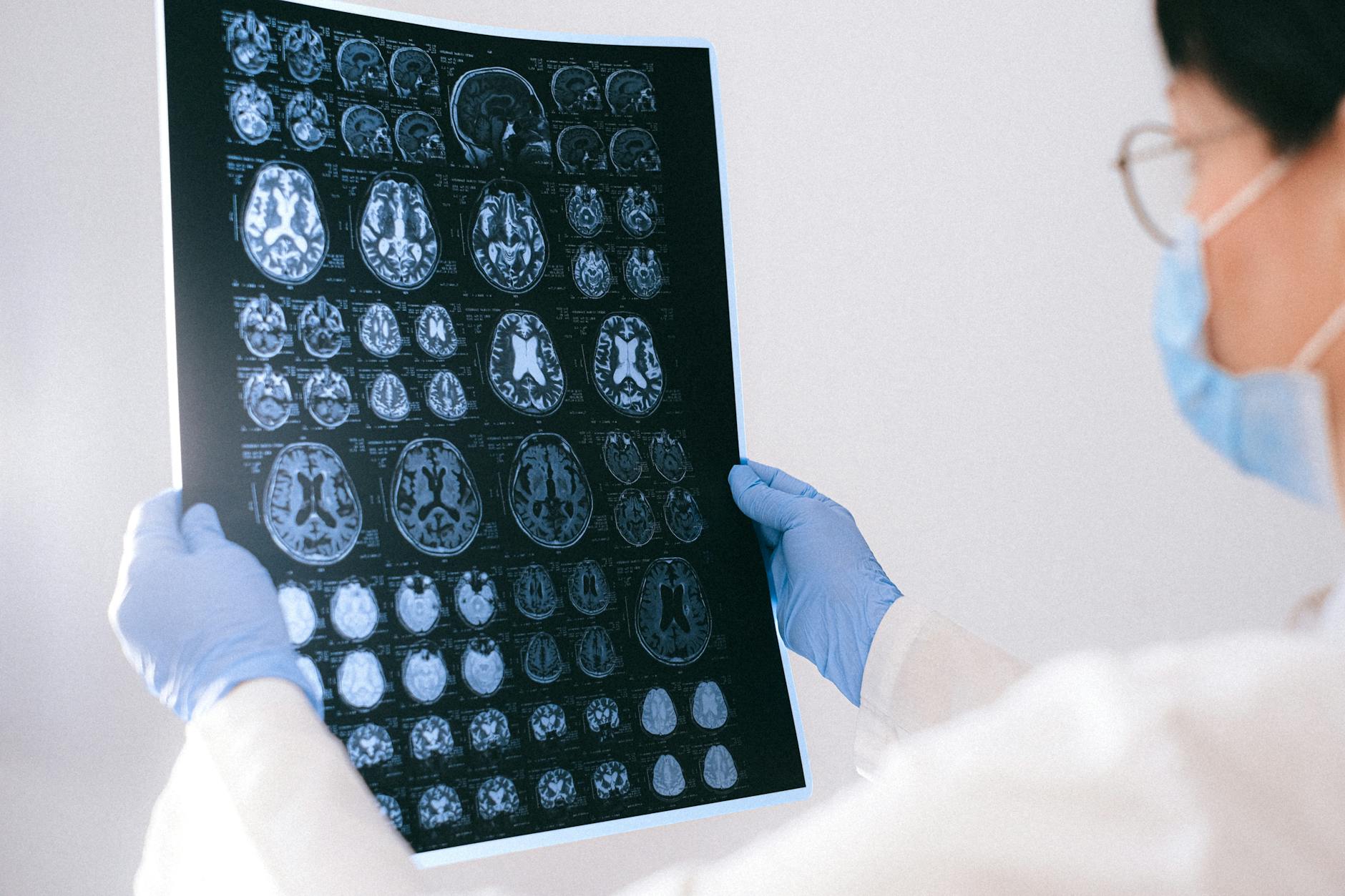 Brain MRI scan showing cortical structure — Alzheimer's neurodegeneration imaging